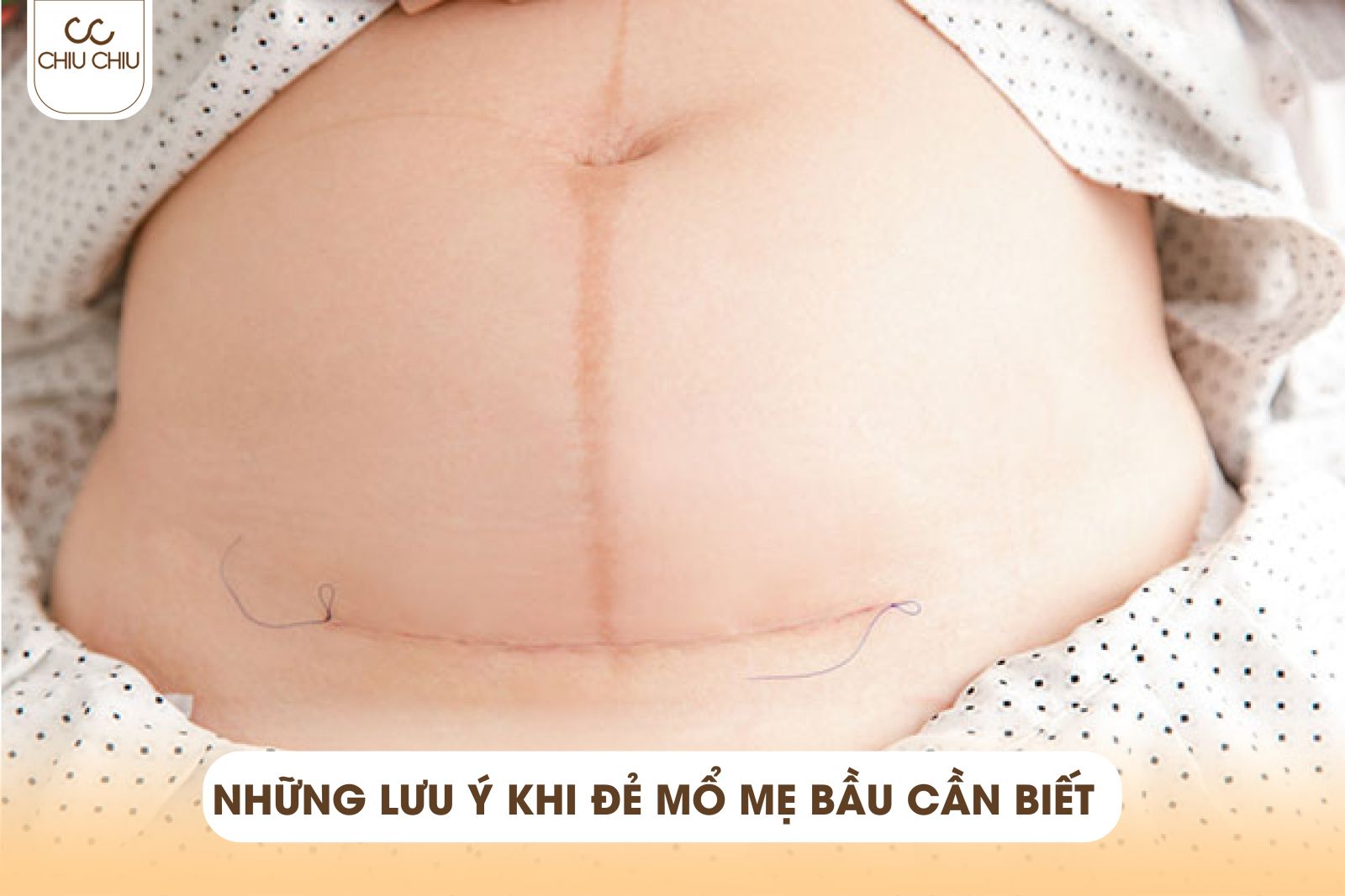 Những Lưu Ý Khi Đẻ Mổ Mà Các Mẹ Bầu Cần Biết